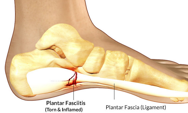 best way to heal plantar fasciitis